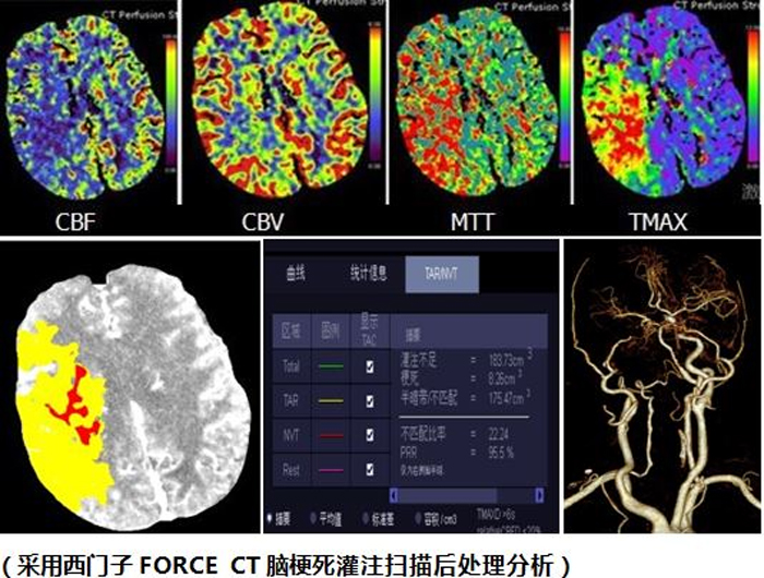 腦灌注2.jpg
