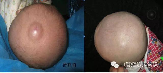 修殘補缺道 醫(yī)美整形路——幫寶寶遠離紅斑-血管瘤