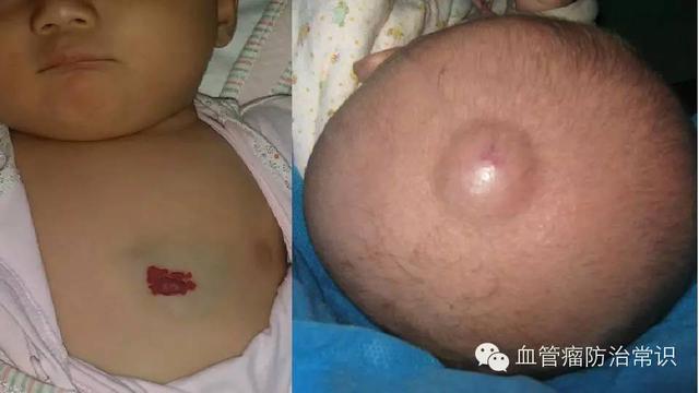 修殘補缺道 醫(yī)美整形路——幫寶寶遠離紅斑-血管瘤