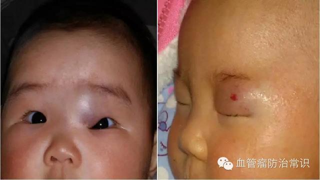 修殘補缺道 醫(yī)美整形路——幫寶寶遠離紅斑-血管瘤