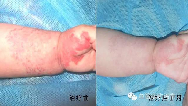 修殘補缺道 醫(yī)美整形路——幫寶寶遠離紅斑-血管瘤