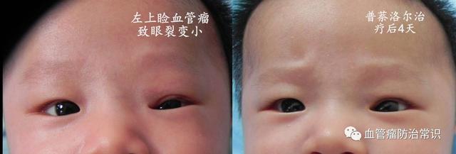 修殘補缺道 醫(yī)美整形路——幫寶寶遠離紅斑-血管瘤